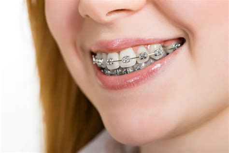 brackets metalicos o invisalign|brackets dentales.